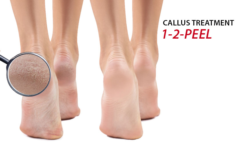 1-2-Peel Callus Treatment for your feet